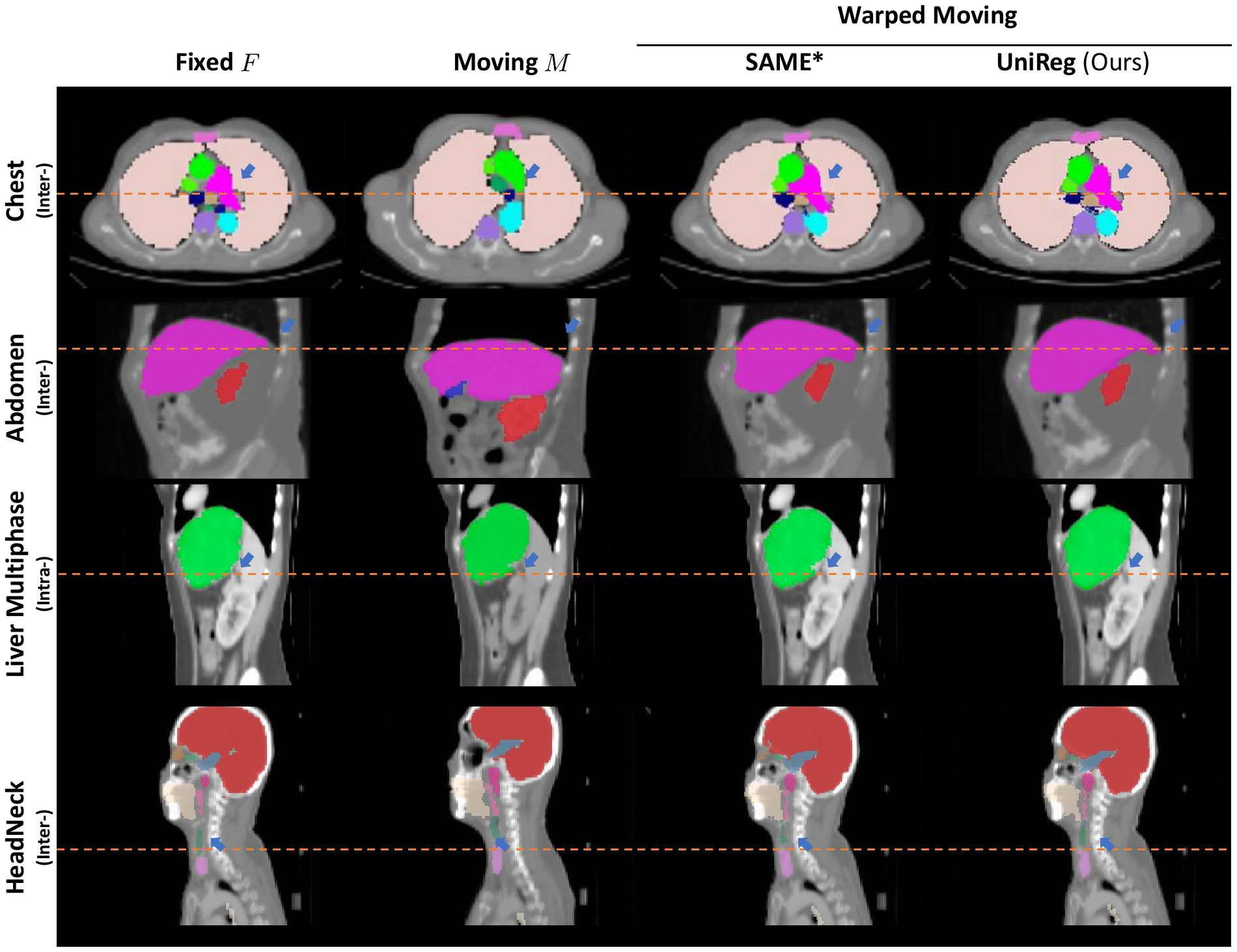 Qualitative registered CT slices and segmentation overlays